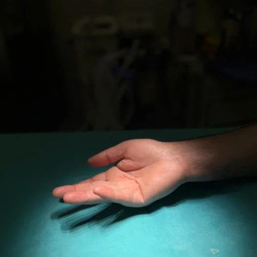Dupuytren kontraktürü nedeniyle avuç içinin masaya tam temas etmediğini gösteren el muayenesi - Op. Dr. Numan Atılgan Gaziantep El Cerrahisi.