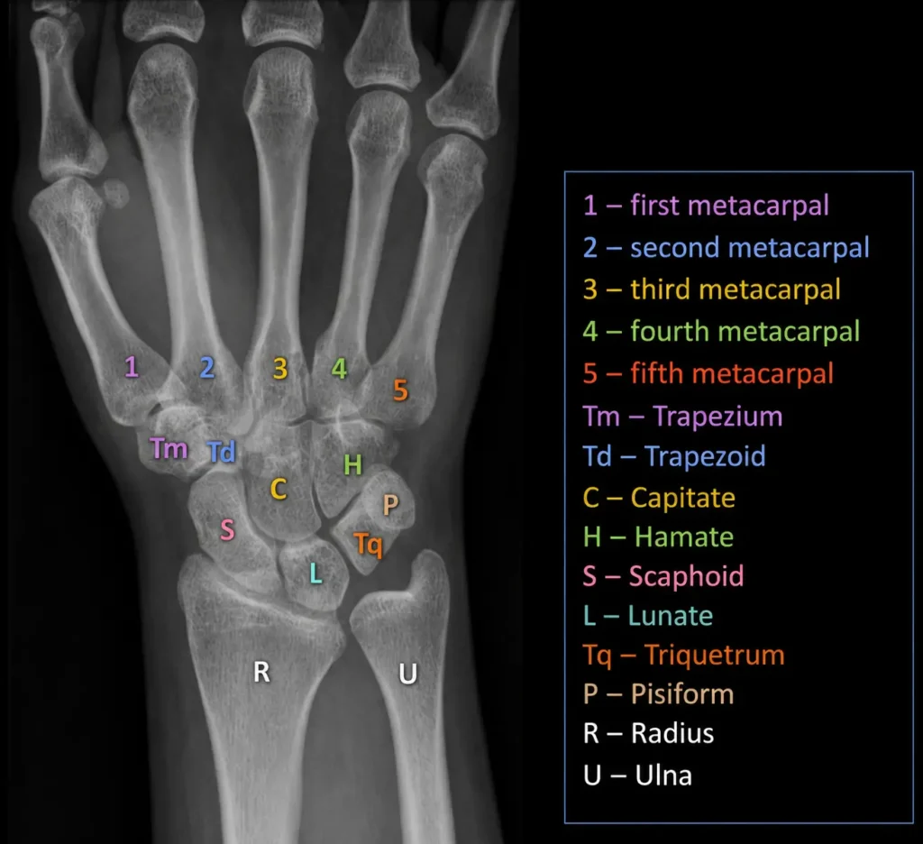 El bileğinin ön-arka (PA) röntgen görüntüsünde skafoid, lunat, trikuetrum, pisiform, trapezyum, trapezoid, kapitat ve hamatum kemiklerini gösteren renk kodlu anatomik şema.