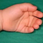 Sindaktili (parmakların birleşik olması) olan bebek elinin klinik görünümü