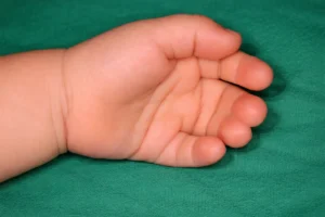 Sindaktili (parmakların birleşik olması) olan bebek elinin klinik görünümü
