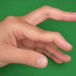 El Cerrahisi Kliniği Kuğu Boynu Deformitesi görünüm.