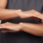 İki el bileğinde de belirgin olan bilateral Madelung deformitesi görünümü; el bileği ekleminde ulnar kemiğin dorsal çıkıntısı ve eğriliği