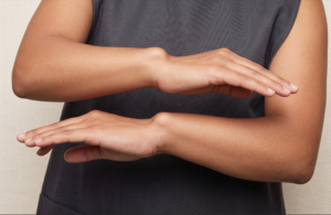 İki el bileğinde de belirgin olan bilateral Madelung deformitesi görünümü; el bileği ekleminde ulnar kemiğin dorsal çıkıntısı ve eğriliği