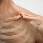 Orta şaft köprücük kemiği kırığı kemik uçlarının yer değiştirmesini ve ciltte belirgin çıkıntıyı gösteren 3D anatomik medikal illüstrasyon