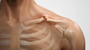 Orta şaft köprücük kemiği kırığı kemik uçlarının yer değiştirmesini ve ciltte belirgin çıkıntıyı gösteren 3D anatomik medikal illüstrasyon
