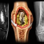 Osteomiyelit tanı ve tedavi rehberi Gaziantep Ortopedi Kliniği