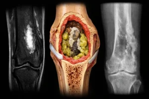 Osteomiyelit tanı ve tedavi rehberi Gaziantep Ortopedi Kliniği