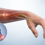 El ve ön kolda periferik sinir yaralanmasını gösteren yarı gerçekçi 3D tıbbi illüstrasyon. Bilek düşüklüğü, kas güçsüzlüğü, sinir iletim kaybı ve radial, median ile ulnar sinir anatomisi şeffaf katmanla gösterilmektedir.