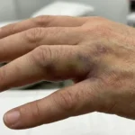 el parmağı -proksimal falanks kırığı klinik görünüm