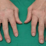 Romatoid artrit klinik görünüm Gaziantep El Cerrahisi Kliniği