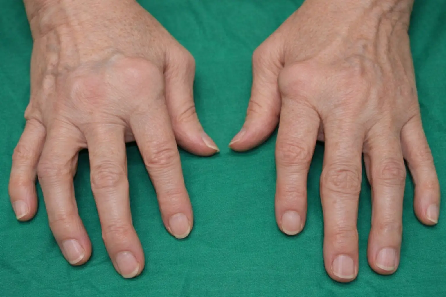 Romatoid artrit klinik görünüm Gaziantep El Cerrahisi Kliniği