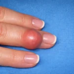 Gaziantep El Cerrahisi Kliniğinde elinde tendon kılıfı dev hücreli tümörü olan hastanın el görünümü.