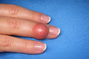 Gaziantep El Cerrahisi Kliniğinde elinde tendon kılıfı dev hücreli tümörü olan hastanın el görünümü.