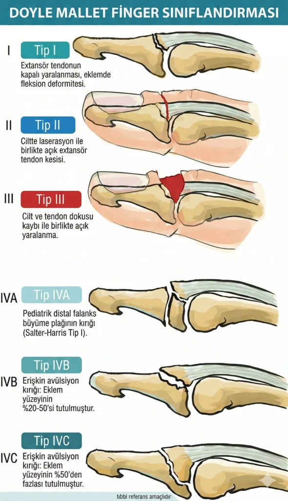 Mallet Finger Doyle Sınıflandırması İnfografik