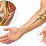 Ulnar sinirin dirsek (kubital tünel) bölgesinden ele uzanan anatomik yolu, serçe parmak uyuşması ve sinir sıkışmasını gösteren tıbbi illüstrasyon.