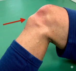 Osgood-Schlatter hastalığı klinik görünüm.