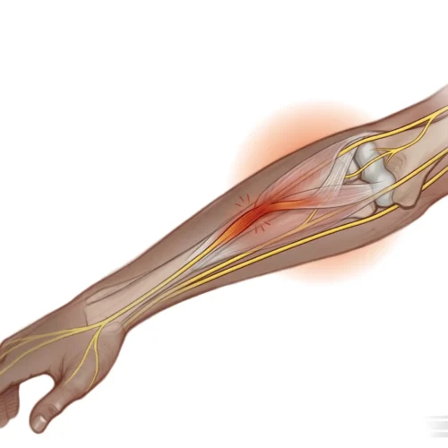 Radyal Tünel Sendromu anatomikgösteriminfografiği
