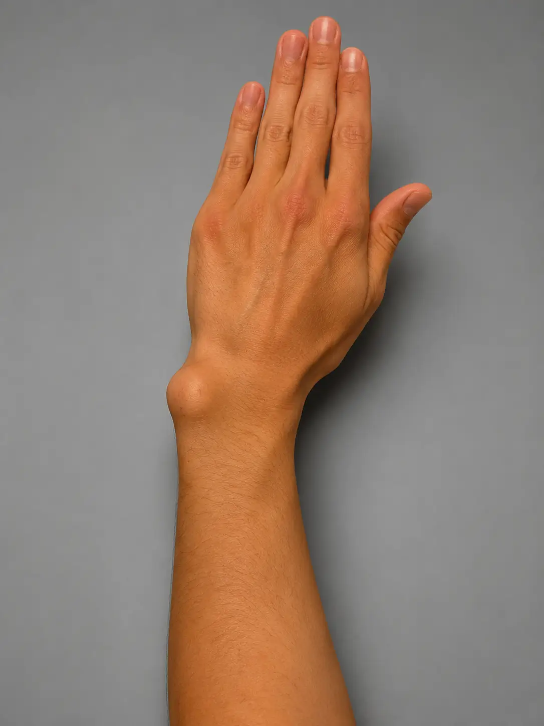 Distal radius malunionuna bağlı el bileği deformitesini gösteren klinik görünüm