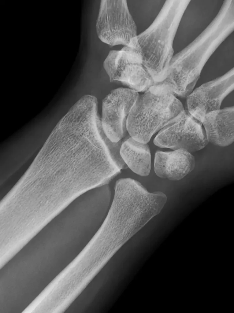 DRUJ instabilitesini gösteren lateral el bileği röntgeni. Distal radioulnar eklemde uyumsuzluk ve hafif subluksasyon görünümü izlenmektedir.