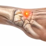 El bileğinde skafoid waist nonunion ve radial tarafta ağrı lokalizasyonunu gösteren medikal görsel