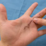 El tendon yapışıklığı nedeniyle tenoliz ameliyatı uygulanmış elde cerrahi kesi görünümü
