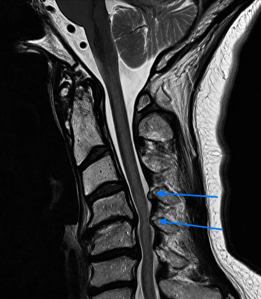 Boyun fıtığına bağlı servikal disk hernisini gösteren sagittal MR görüntüsü. Mavi oklar omurilik kanalına doğru taşan ve sinir dokularına baskı yapan disk protrüzyonlarını işaret etmektedir.