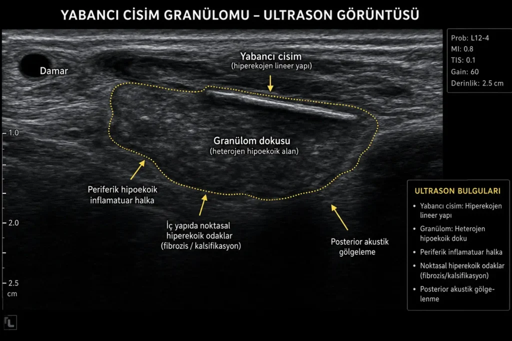 Yabancı cisim granülomunda ultrasonografi bulgularını gösteren tıbbi infografik. Hiperekojen yabancı cisim, çevresindeki granülom dokusu, inflamatuar halka ve posterior akustik gölgelenme izlenmektedir.
