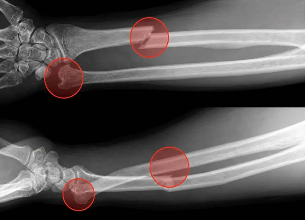 Galeazzi kırığını gösteren ön kol AP ve lateral röntgen görüntüleri. Radius şaft kırığı ve distal radioulnar eklem (DRUE) yaralanması kırmızı dairelerle işaretlenmiştir.