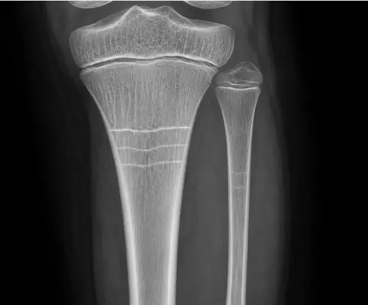 Cam kemik Hastalığı olan bir hastada tibia ve fibulanın ön-arka radyografik görüntüsü. Tibia ve fibulanın proksimal ve distal metafizlerinde radyografik büyüme durma çizgileri görülmektedir.